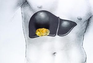 cholelithiasis 담석증