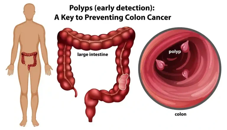 대장 용종 colon polyp