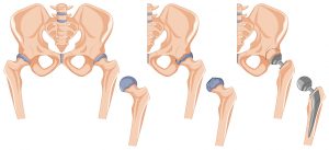 대퇴골 경부골절 fracture of femur