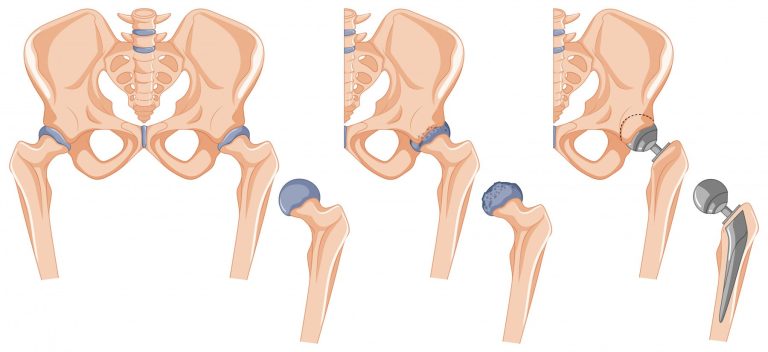 대퇴골 경부골절 fracture of femur