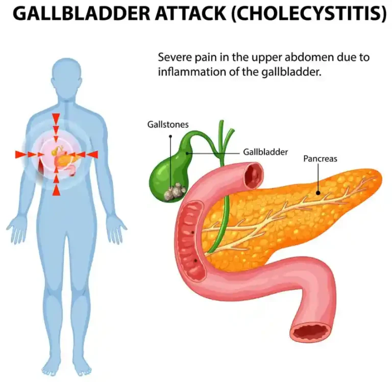 담낭염 cholecystitis