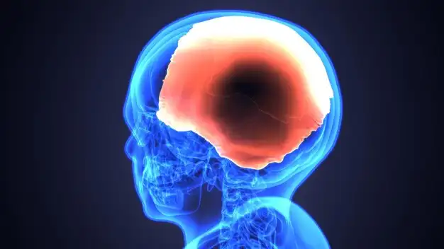 meningitis 수막염