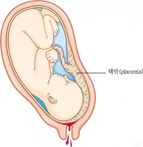 전치태반