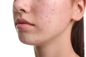 여드름 acne