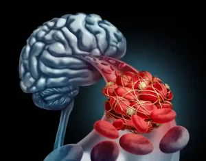 뇌경색 cerebral infarction